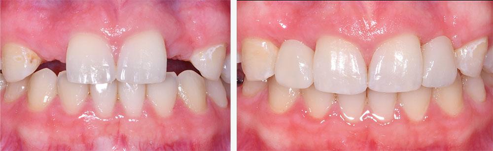 Patient with missing lateral incisors