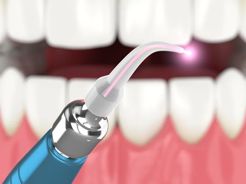 Bay Star Dental: Diode laser periodontal therapy gum disease